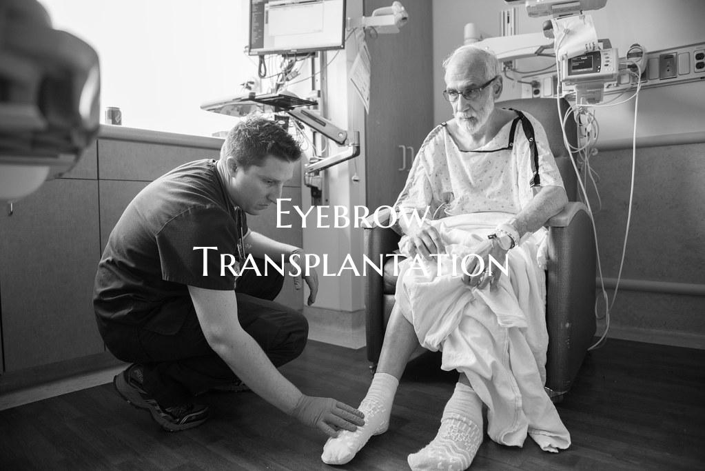 Eyebrow Transplantation